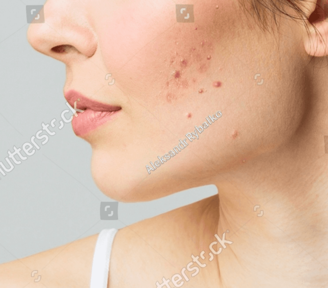 Acne op de wang van een persoon