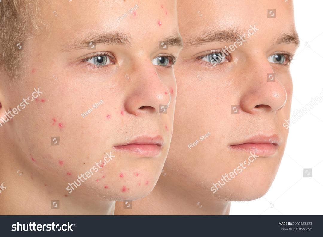 Acne op het gezicht van een jong persoon